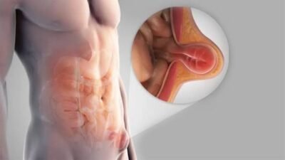 Hernia Surgery