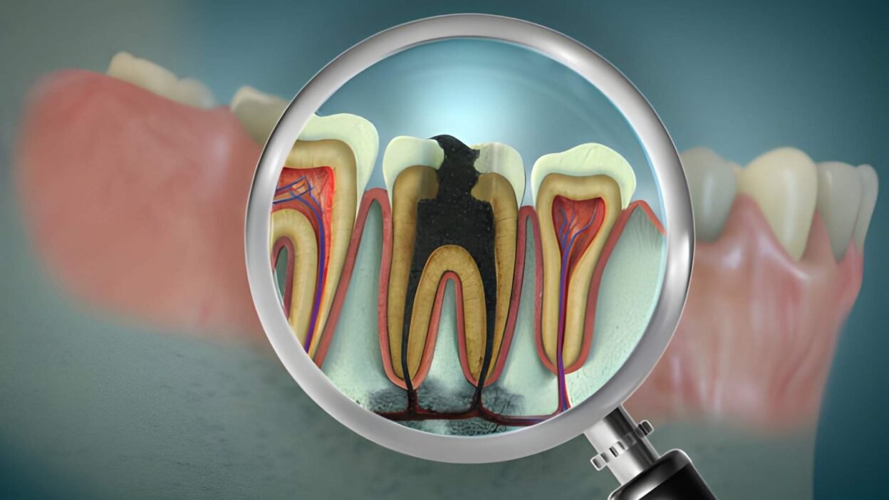 Root Canal Treatment in Johar Town
