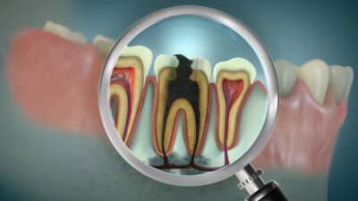 Root Canal Treatment in Johar Town